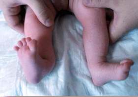 Déformation de Valgo dans les symptômes des enfants
