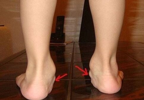 Déformation de la valgue des pieds chez les enfants