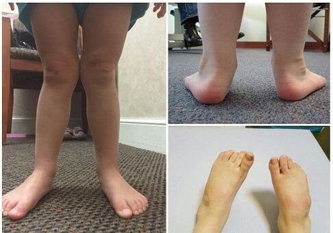 Déformation de Valgo chez les enfants