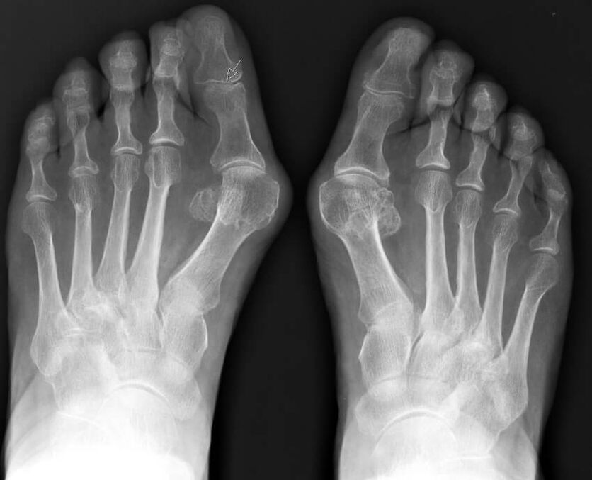 radiographie de l'hallux valgus
